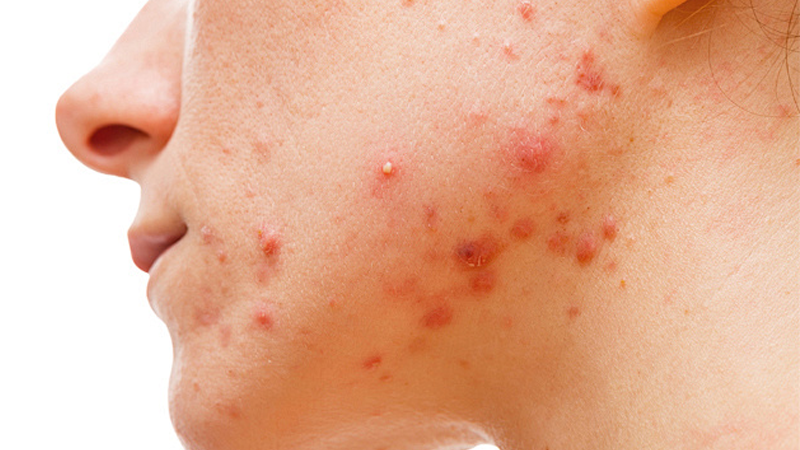 Revolutionizing Acne Care: The Power of Science-Backed Formulations